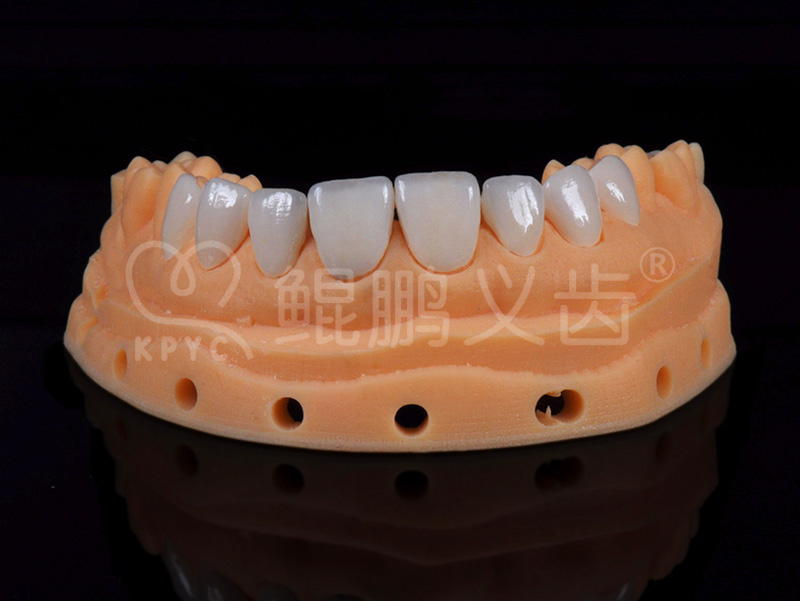 貝特福貼面
